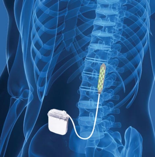 Spinal Cord Stimulation